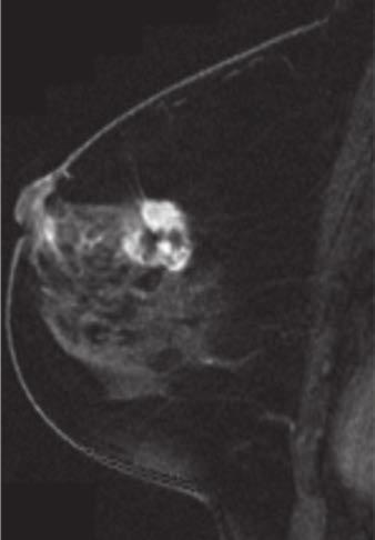 , Contrast-enhanced fat-suppressed image shows rapid peripheral enhancement (arrow), and central