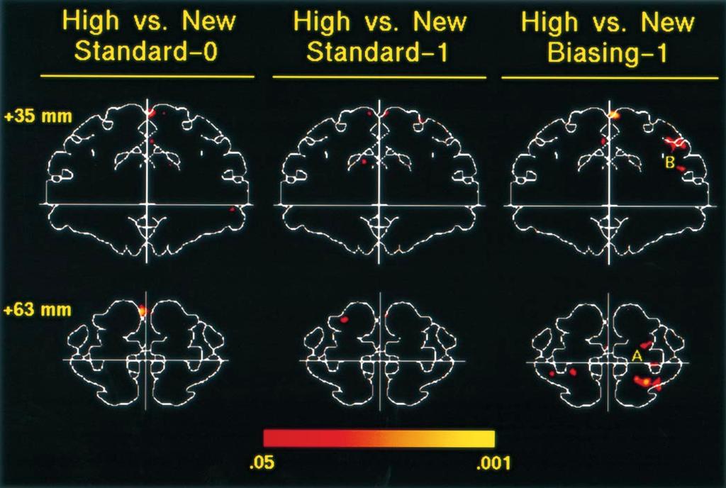 1996 A. D. Wagner et al. Fig. 4 Composite coronal images of activation in two sections corresponding to 35 and 63 mm rostral to the AC.