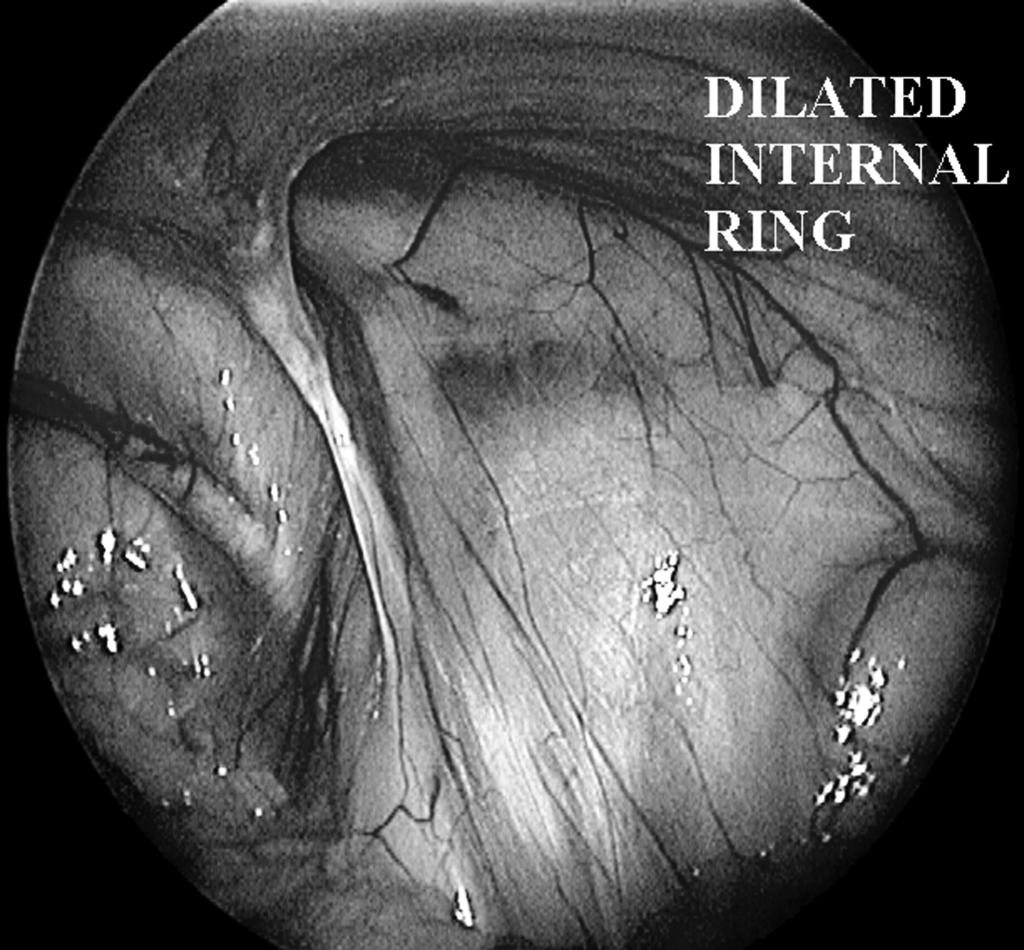 Laparoscopic ring closure: continuation of the purse string on the