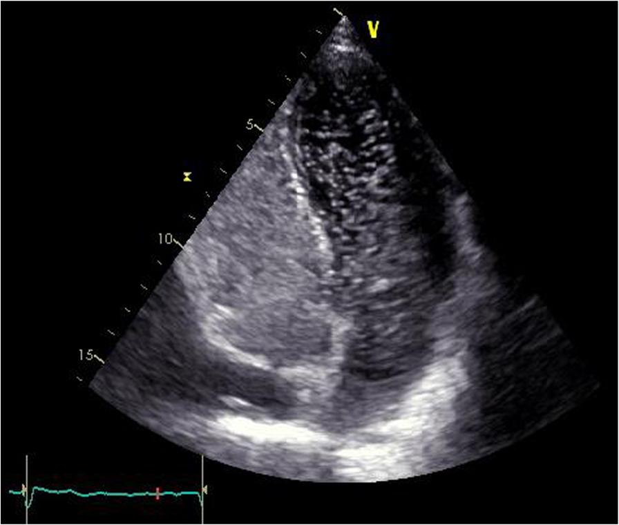 de Picciotto et al. Journal of Medical Case Reports (2017) 11:234 Page 3 of 5 Fig. 1 a Respiratory polygraphy.