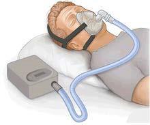 FAQ s What if my patient has CPAP? EtCO 2 monitoring is possible with CPAP.