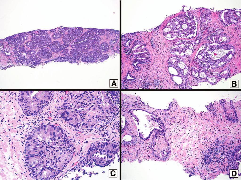 Figure 1. A, Intraductal carcinoma of the prostate is often extensive and forms solid nests.