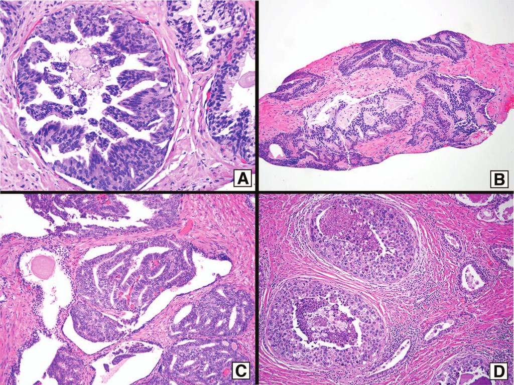 Figure 2. The major differential diagnoses for intraductal carcinoma of the prostate (IDC-P) are pictured.