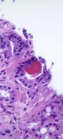 amphophilia Glomerulations Perineural