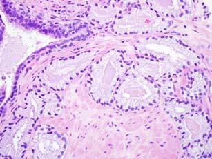 prostate cancer Over-expression of protein in