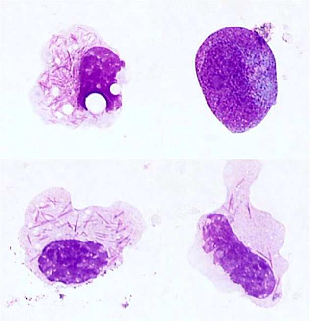normal neutrophils and malign neutrophils (ATRA induces
