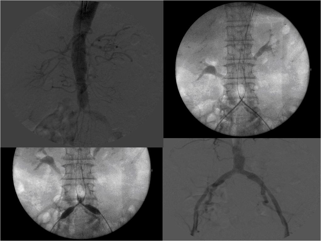 Bilateral Iliac angioplasty Case 7: Recent angiography shows near occlusion of the common iliac arteries bilaterally. Patient admitted for intervention.
