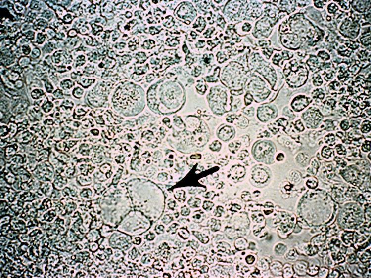 display various malignant features, such as high nuclear to cytoplasmic