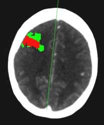 Example 3: Infarct Core MTT: right frontal perfusion