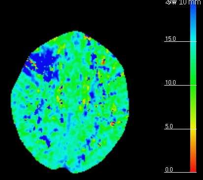 with mostly low CBV Dark center = infarct core