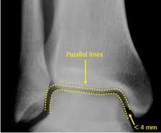 Ankle Anatomy Ankle mortise The key to understanding the ankle in function A well-aligned mortise represents ankle alignment, fibular