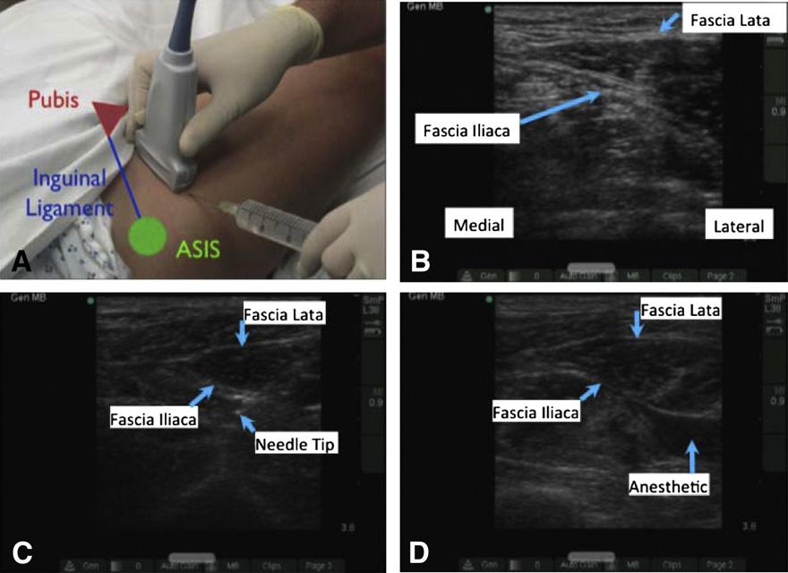 694 L. Haines et al. Figure 1. (A) Placing the ultrasound-guided fascia iliaca compartment block (UFIB). ASIS = anterior superior iliac spine.