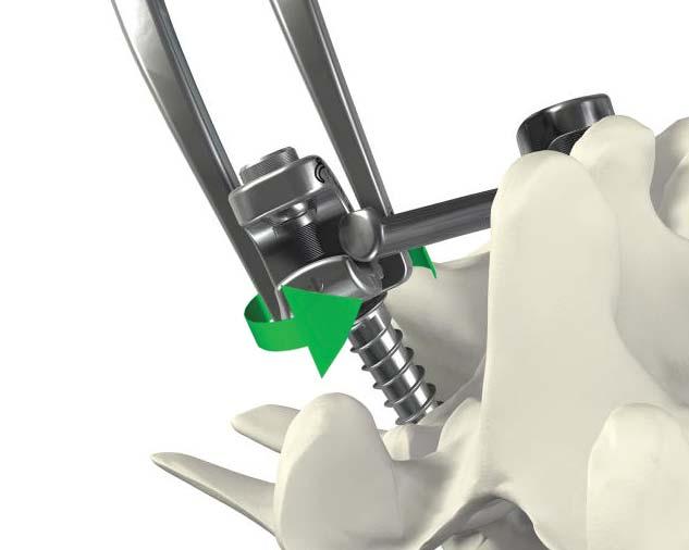 On the patient s right side, begin to provisionally tighten the screws at the caudal end first.