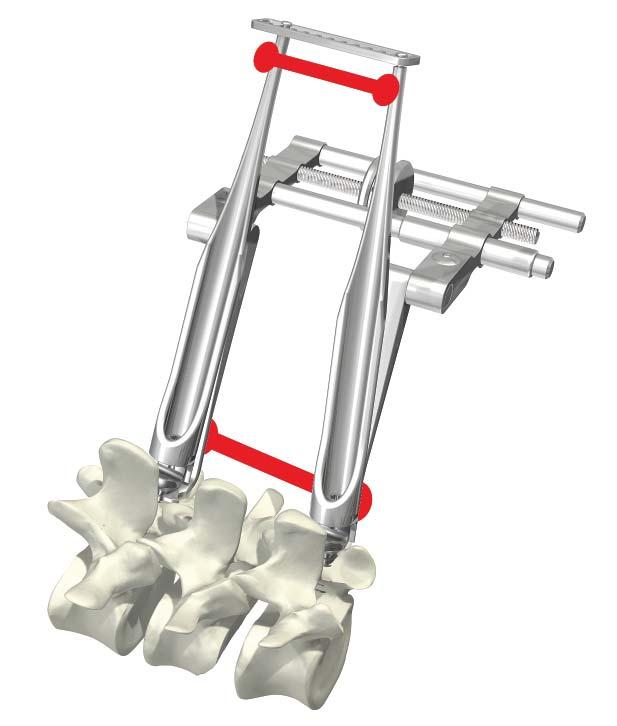 Step 5 Distraction of the anterior space By moving the tips of the levers together, the anterior space of the vertebral bodies will be opened to reduce the fracture.