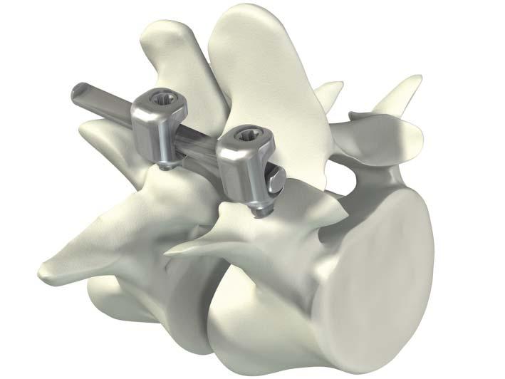 SURGICAL TECHNIQUE Easyspine Under laminar hook Concept The Easyspine under laminar hook was designed to be used in the lumbar region as an angled offset