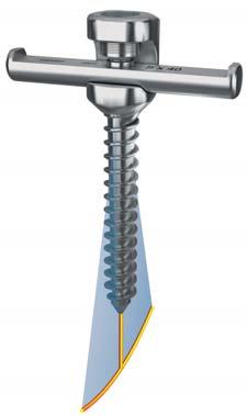 SURGICAL TECHNIQUE Easyspine Standard or Alpha screw selection and assembly Step 3 Standard or Alpha screw selection The Easyspine Standard and Alpha screws can be used