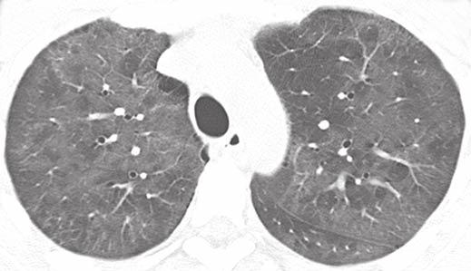 CT of Pneumocystis jiroveci Pneumonia pneumonia between malignancy cases and acquired immunodeficiency syndrome cases: a multicenter study. Intern Med 2010; 49:273 281 12.