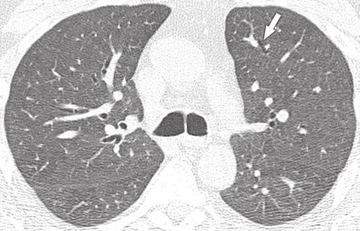 Kovacs J, Hiemenz JW, Macher M, et al. Fig. 1 38-year-old man with IDS and Pneumocystis jiroveci pneumonia.