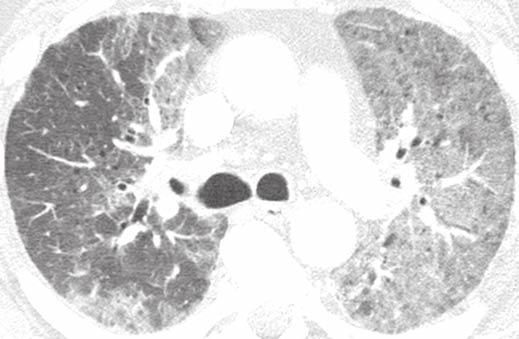 CT of Pneumocystis jiroveci Pneumonia Fig. 8 67-year-old man with IDS and Pneumocystis jiroveci pneumonia (PJP).