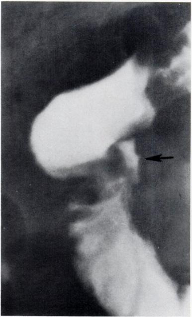 Most are on the medial wall of the duodenum and result in an incisura on the lateral wall. This characteristic asymmetric ring stricture may help identify the location of the ulcer.