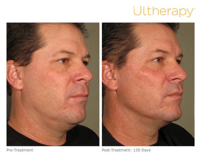 Is Ultherapy safe? The procedure has been cleared by the FDA after demonstrating safety in clinical studies, and over 100,000 treatments have been performed safely worldwide.