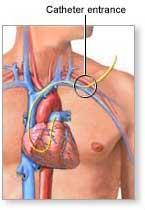 PA Catheter- Complications -Bleeding, hemothorax -Clot formation and embolization -Infection, sepsis, endocarditis -PA perforation -Arterial puncture, AV fistula, pseudoaneurysm Left heart entry
