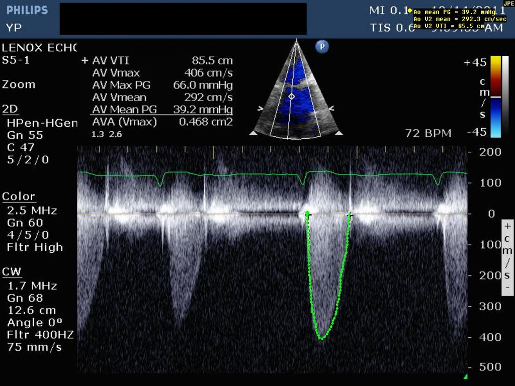 LV systolic pressure = aortic systolic pressure (100) + 70% of AV gradient