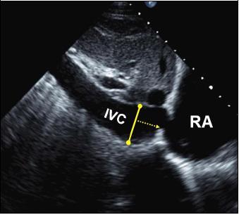 IVC Dimensions IVC diameter 1.7 cm which collapses >50% with a sniff suggests RA pressure 0-5 mmhg IVC diameter > 1.