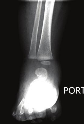 Case Reports in Orthopedics 3 Figure 1: Radiograph of right ankle revealing moderate soft tissue swelling.