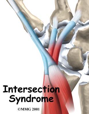 Introduction Intersection syndrome is a painful condition of the forearm and wrist.