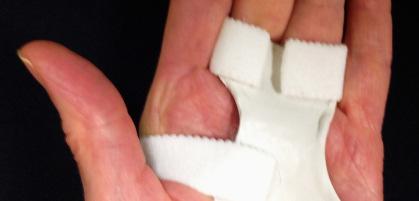 Splint may impair hand function if PIPJ flexion is limited.