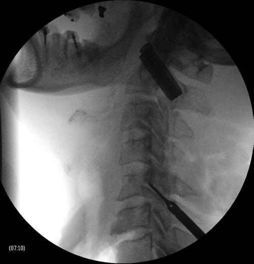 Posterior cervical fusion with the DTRAX Facet System Fig. 7. Left: Intraoperative lateral fluoroscopy view of the DTRAX implant abutting the pedicle of the superior vertebral body.