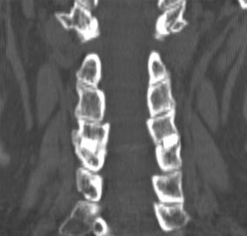 Posterior cervical fusion with the DTRAX Facet System Fig. 10. Coronal CT scan of the DTRAX implant at C4 5 showing intrafacet bridging bone.