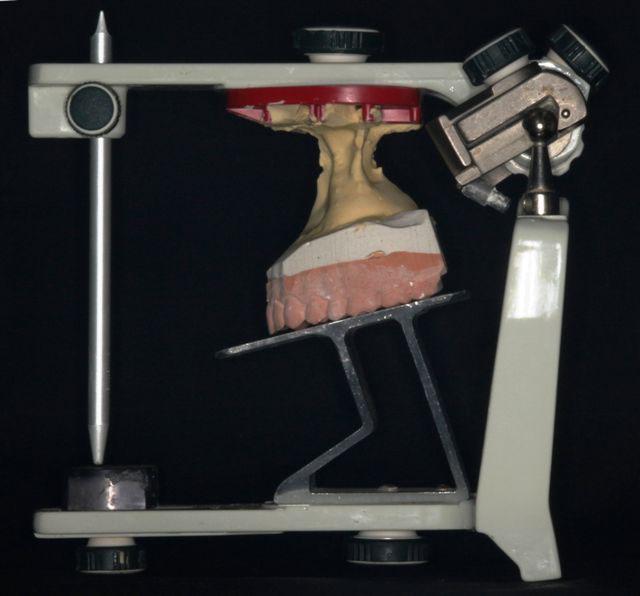 With the use of a compass, recordings in the maxillary mounted model were transferred to cephalometric tracings.