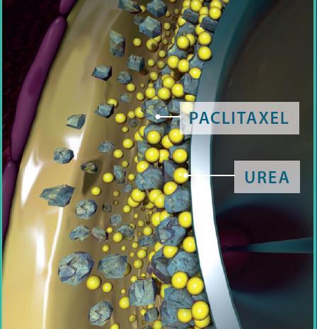 contact with the blood Urea hydrates causing the release of paclitaxel Paclitaxel binds to the wall due to its hydrophobic
