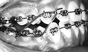 malocclusion. We placed fixed appliances in January 1995 and progressed from 0.016 nickel titanium through to 18/25 nickel titanium to 19/25 steel.