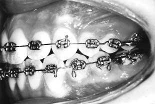 428 Sandler, Atkinson, and Murray American Journal of Orthodontics and Dentofacial Orthopedics April 2000 Fig 16. 0.014 stainless finishing wires for fine detailing of tooth position.