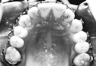 We removed the appliances in August 1996, therefore, the total duration of active treatment to fully correct this malocclusion was 19 months (Fig 12).