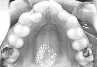The upper and lower right first molars were very heavily filled,
