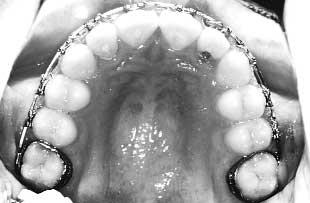 Active treatment time for correction of the malocclusion was 2 1 2 years.