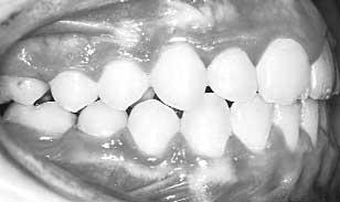 5. Daugaard-Jensen I. Extraction of first molars in discrepancy cases. Am J Orthod 1973;64:115-36. 6.