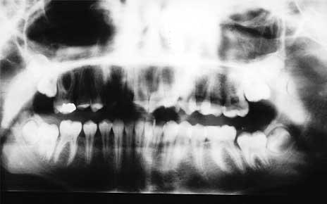 Upper second molars almost completely replace first molars