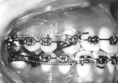 420 Sandler, Atkinson, and Murray American Journal of Orthodontics and Dentofacial Orthopedics April 2000 Fig 7. Stainless steel tubing prevents arch wire distortion and movement. Fig 6.