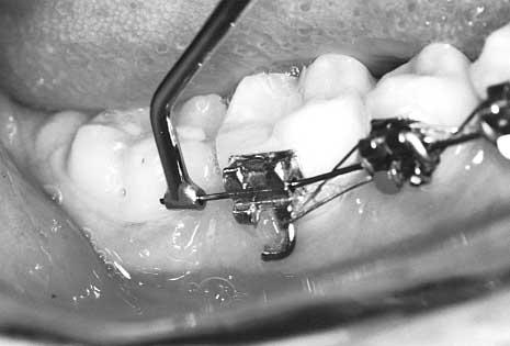 POTENTIAL PROBLEMS Lower Arch Space Closure Space closure is perhaps the most challenging aspect of first molar extraction cases.