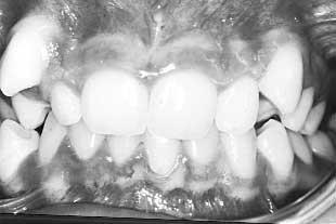 upper first molar extraction spaces is