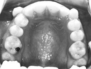 If a reasonable amount of the extraction space is required, consideration should be given to provision of a palatal arch with Nance button on the second