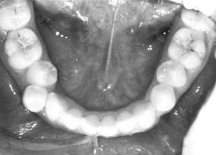 If all the first molar space is required either for relief of crowding or overjet reduction, headgear must be provided to the upper second molars to prevent