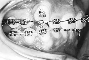 Timing of Extractions If the upper second molars are unerupted at the time of extraction of the upper first molars, they will almost completely replace them,