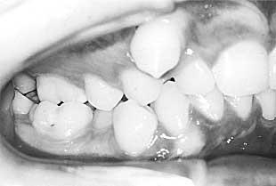 It has been suggested that effective distalization of upper premolars with a removable appliance can be achieved if the first molars are extracted early.