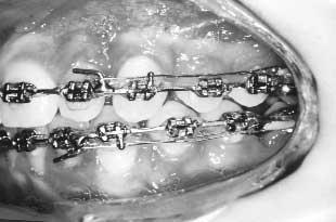 American Journal of Orthodontics and Dentofacial Orthopedics Sandler, Atkinson, and Murray 423 Volume 117, Number 4 Fig 11. 19/25 stainless steel working arch wires.